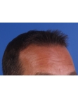 After Hair Transplant&nbsp;2 Sessions (Areas)